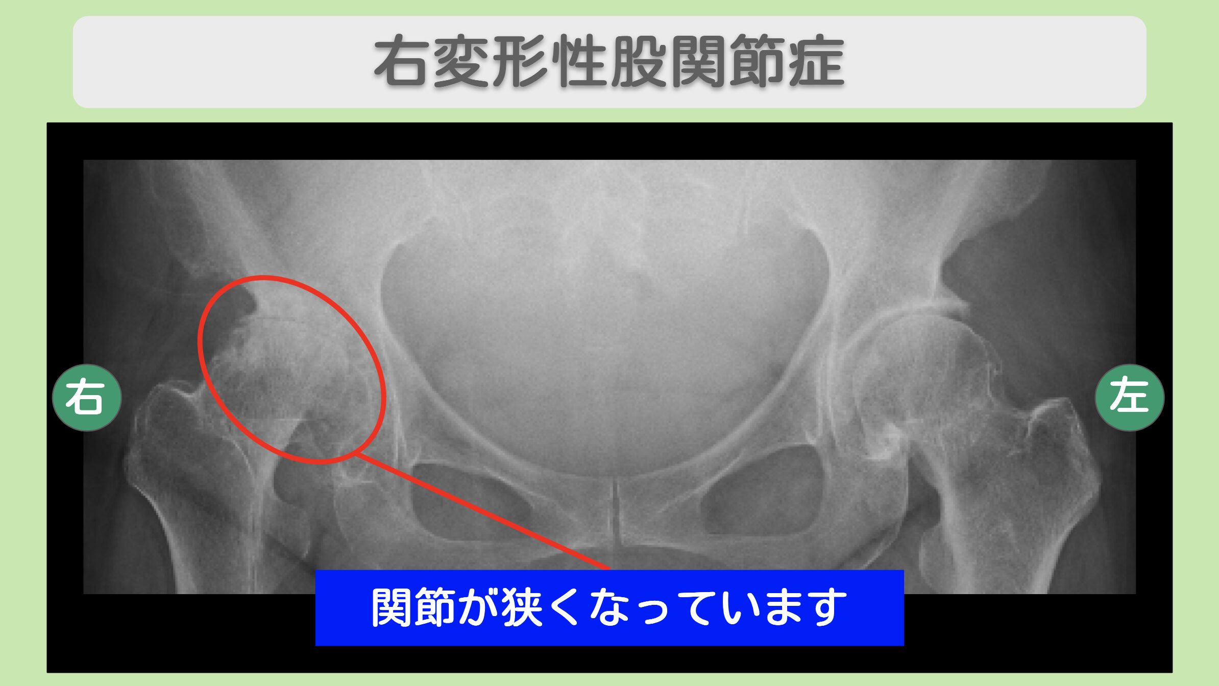 右変形性股関節症のレントゲン所見（関節が狭くなっている）