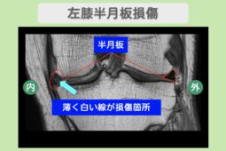 左膝半月板損傷のMRI所見（薄く白い線が損傷箇所）