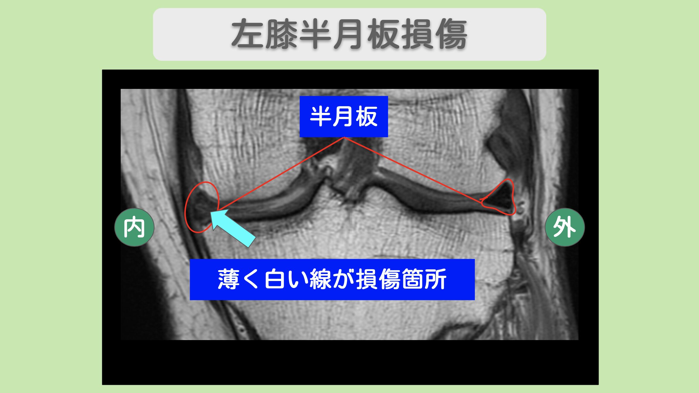 左膝半月板損傷のMRI所見(薄く白い線が損傷箇所)