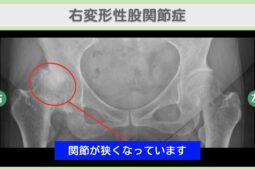 右変形性股関節症
