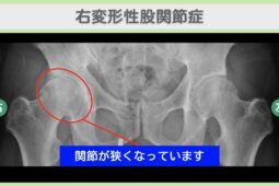 右変形性股関節症