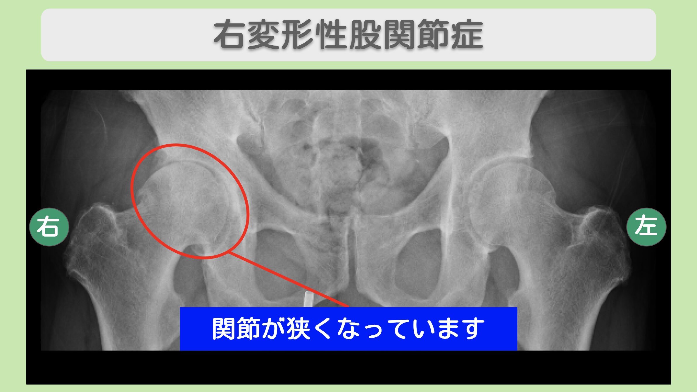 右変形性股関節症