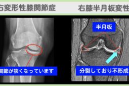 右変形性膝関節症 右膝半月板変性