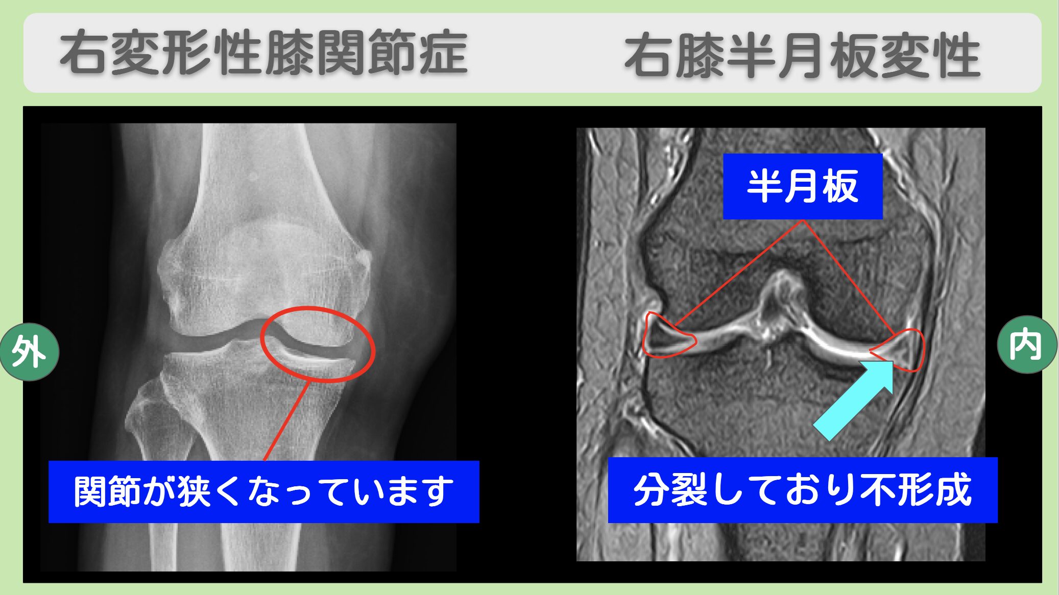 右変形性膝関節症 右膝半月板変性