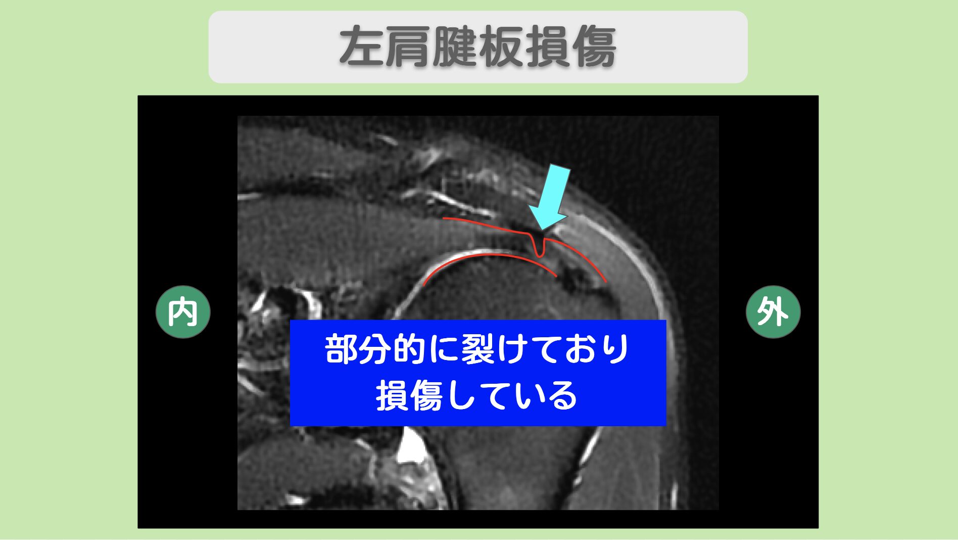 左肩腱板損傷
