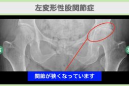 左変形性股関節症