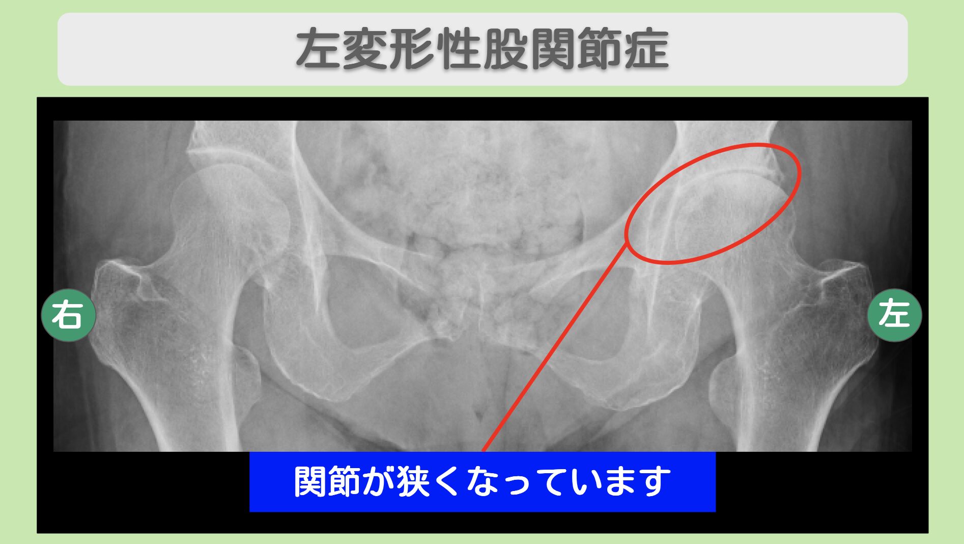 左変形性股関節症