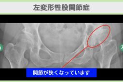 左変形性股関節症