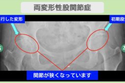 両変形性股関節症