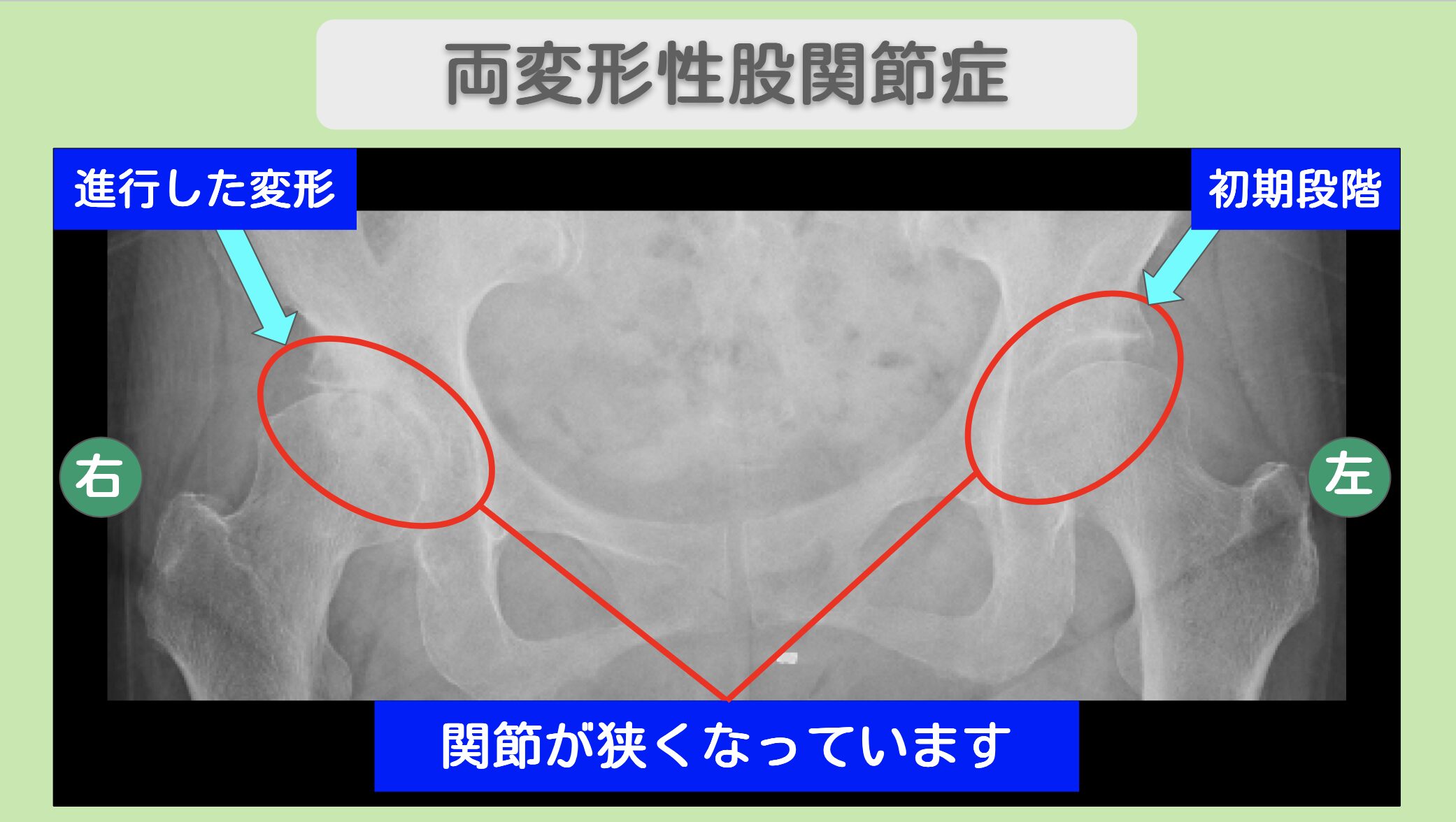 両変形性股関節症