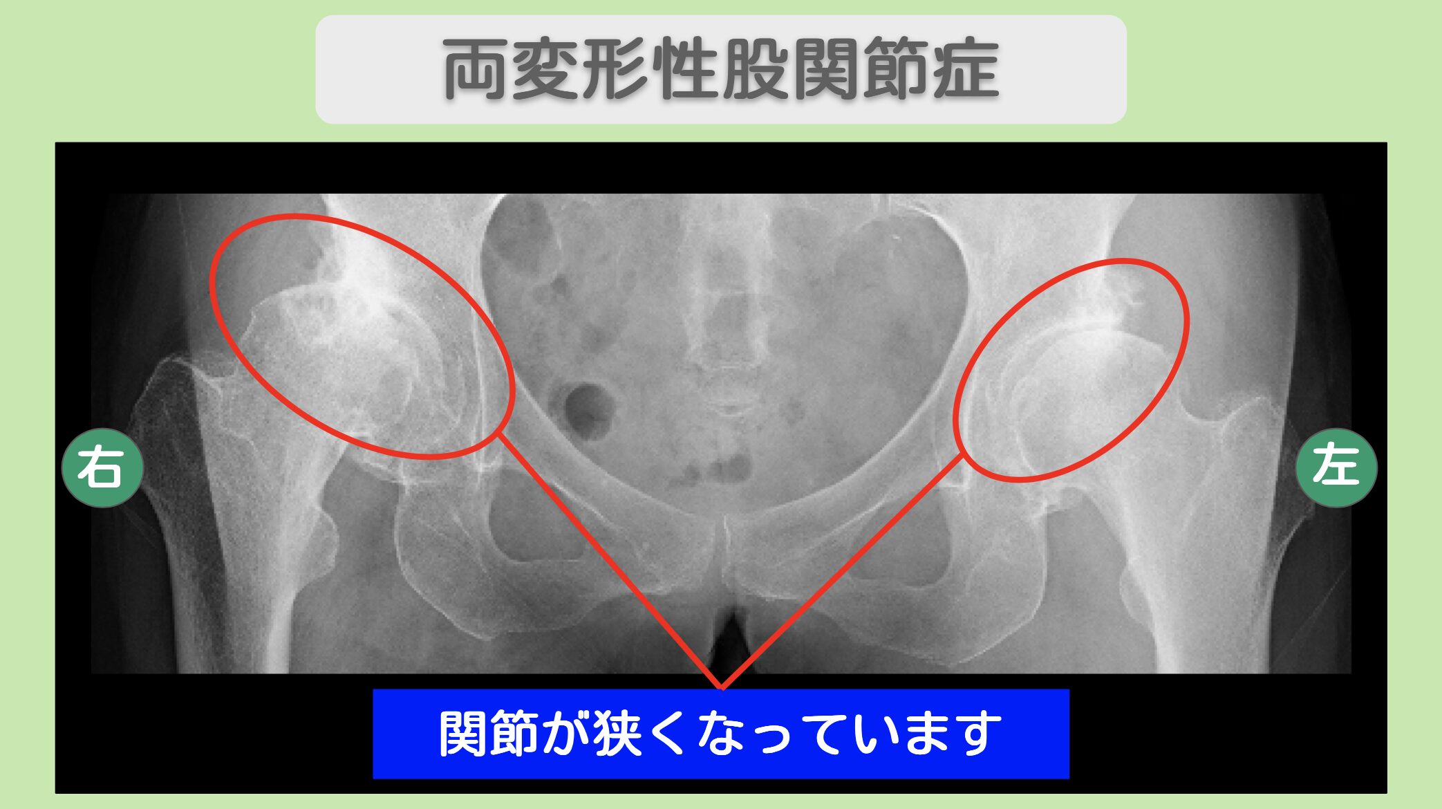 両変形性股関節症