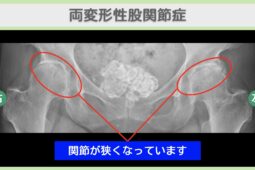 両変形性股関節症