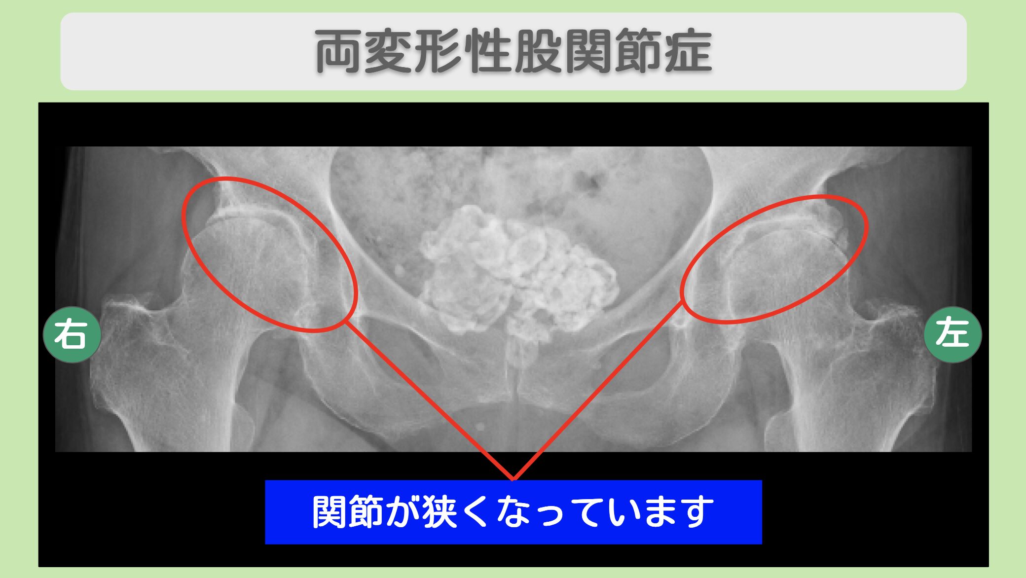両変形性股関節症