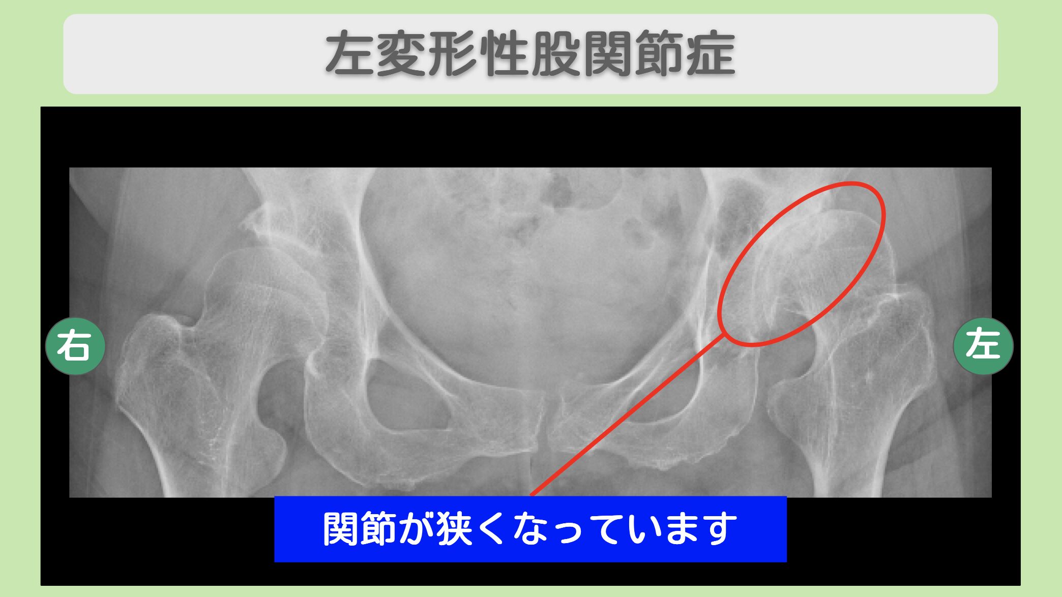 左変形性股関節症
