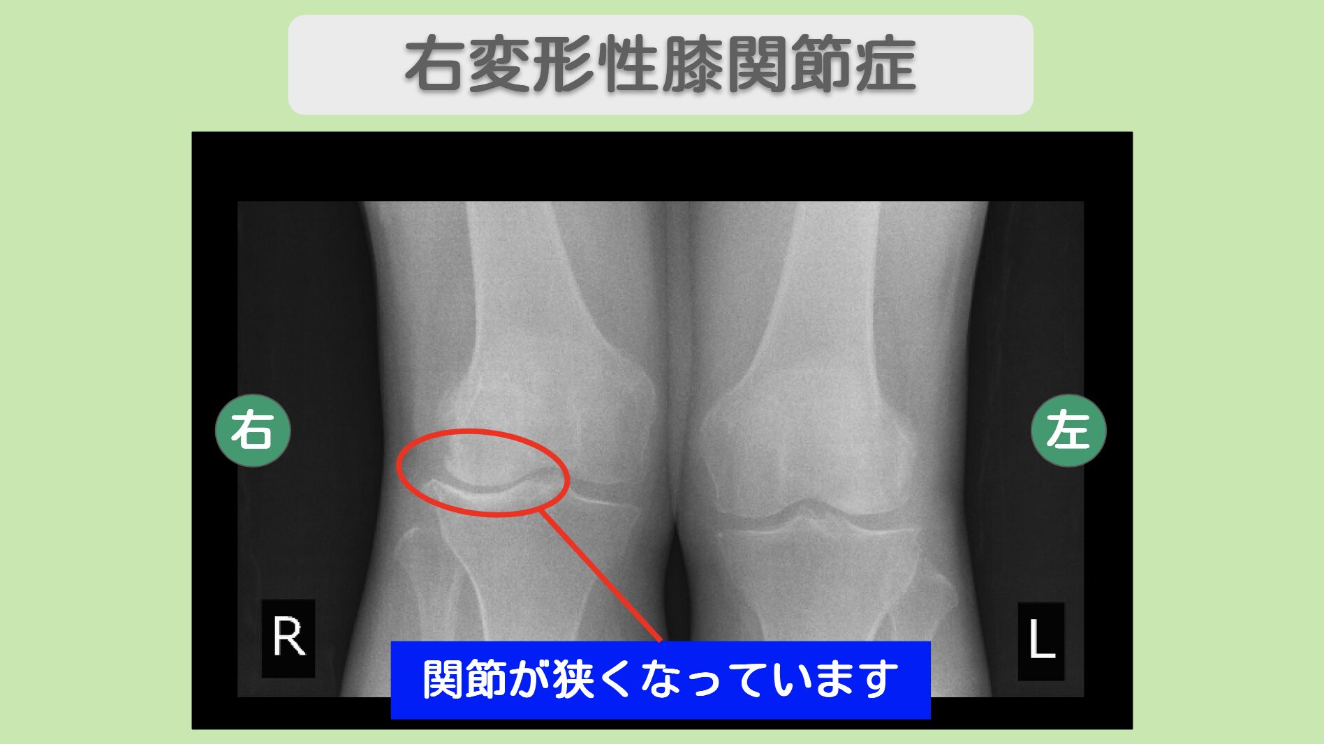 右膝・左股関節レントゲン所見