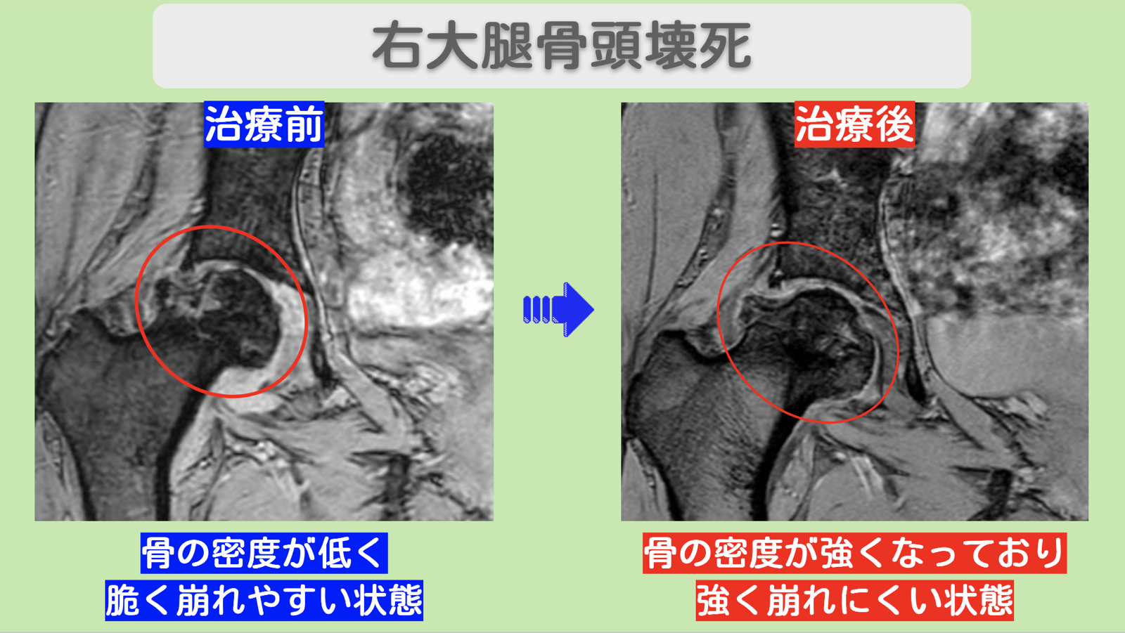 990 hip mri 2026