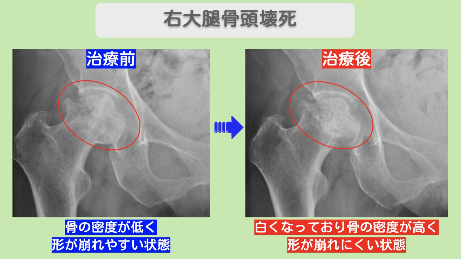 右大腿骨頭壊死症　幹細胞治療
