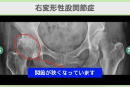 右変形性股関節症のレントゲン所見