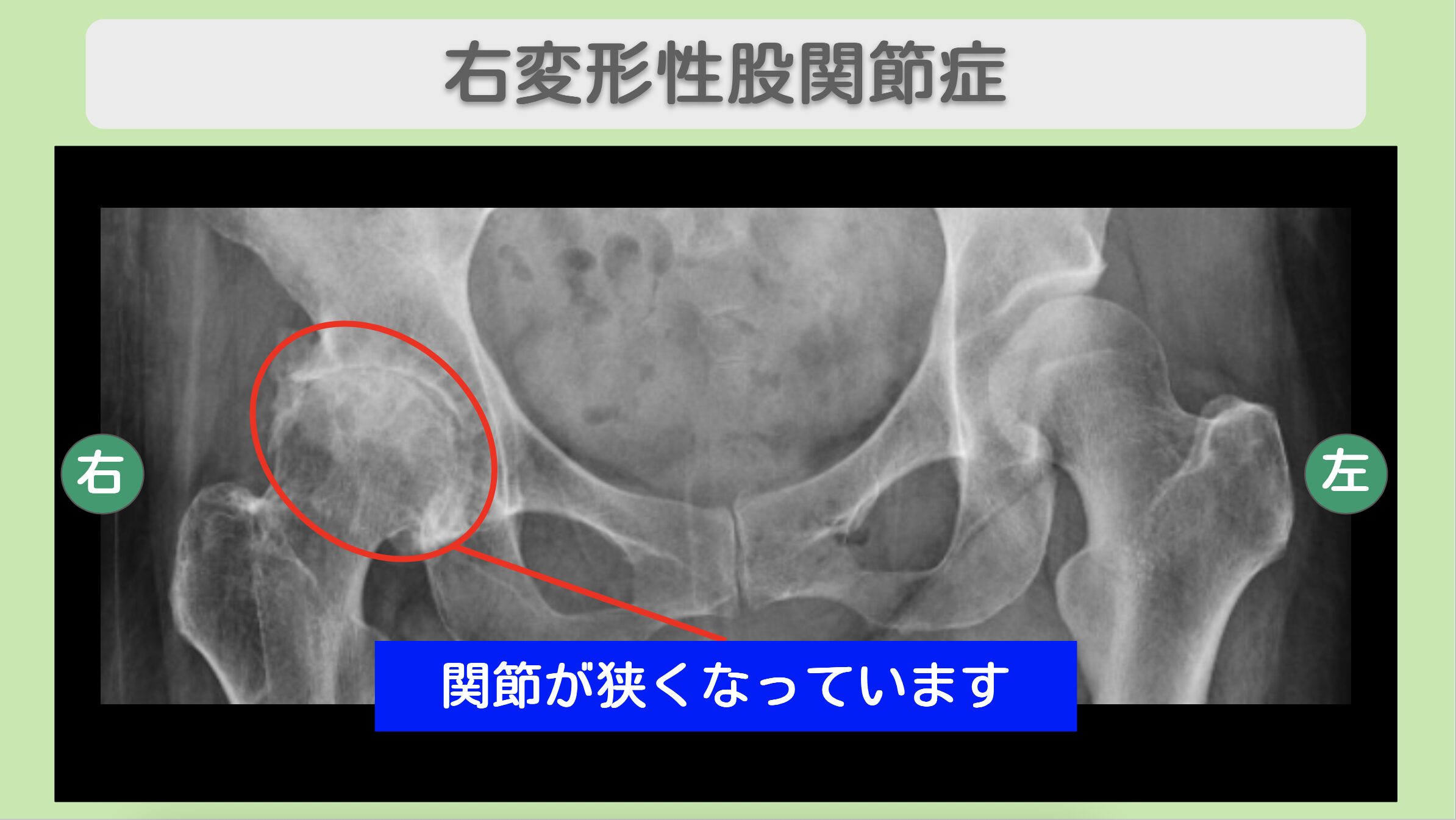 右変形性股関節症のレントゲン所見