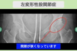 左変形性股関節症のレントゲン所見　関節の狭小化