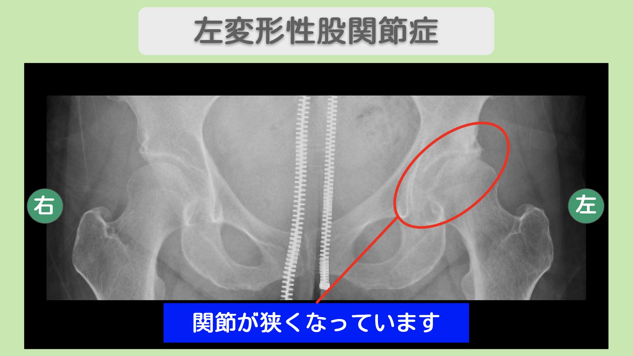 左変形性股関節症のレントゲン所見　関節の狭小化