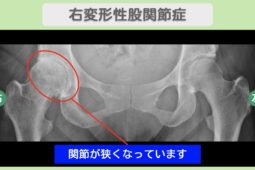 右変形性股関節症