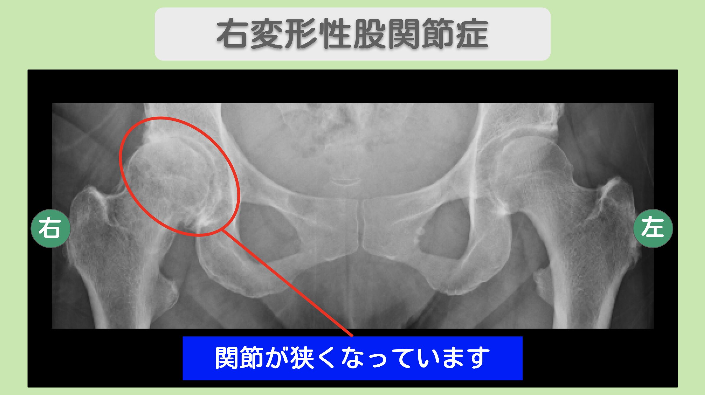 右変形性股関節症