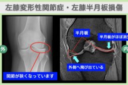 左膝変形性関節症・左膝半月板損傷のMRI・レントゲン所見