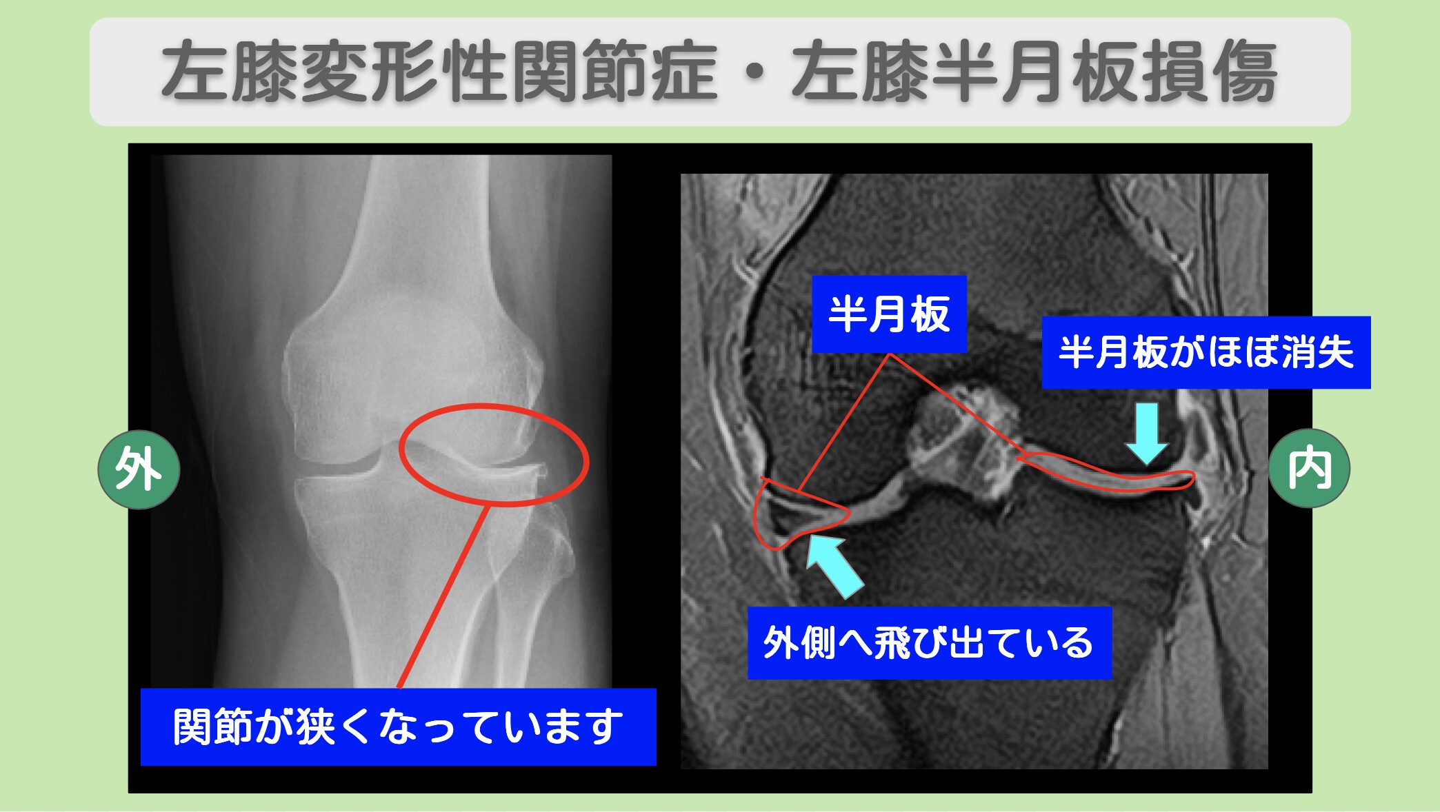 左膝変形性関節症・左膝半月板損傷のMRI・レントゲン所見