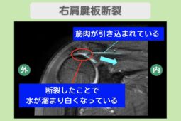 右肩腱板断裂のMRI所見