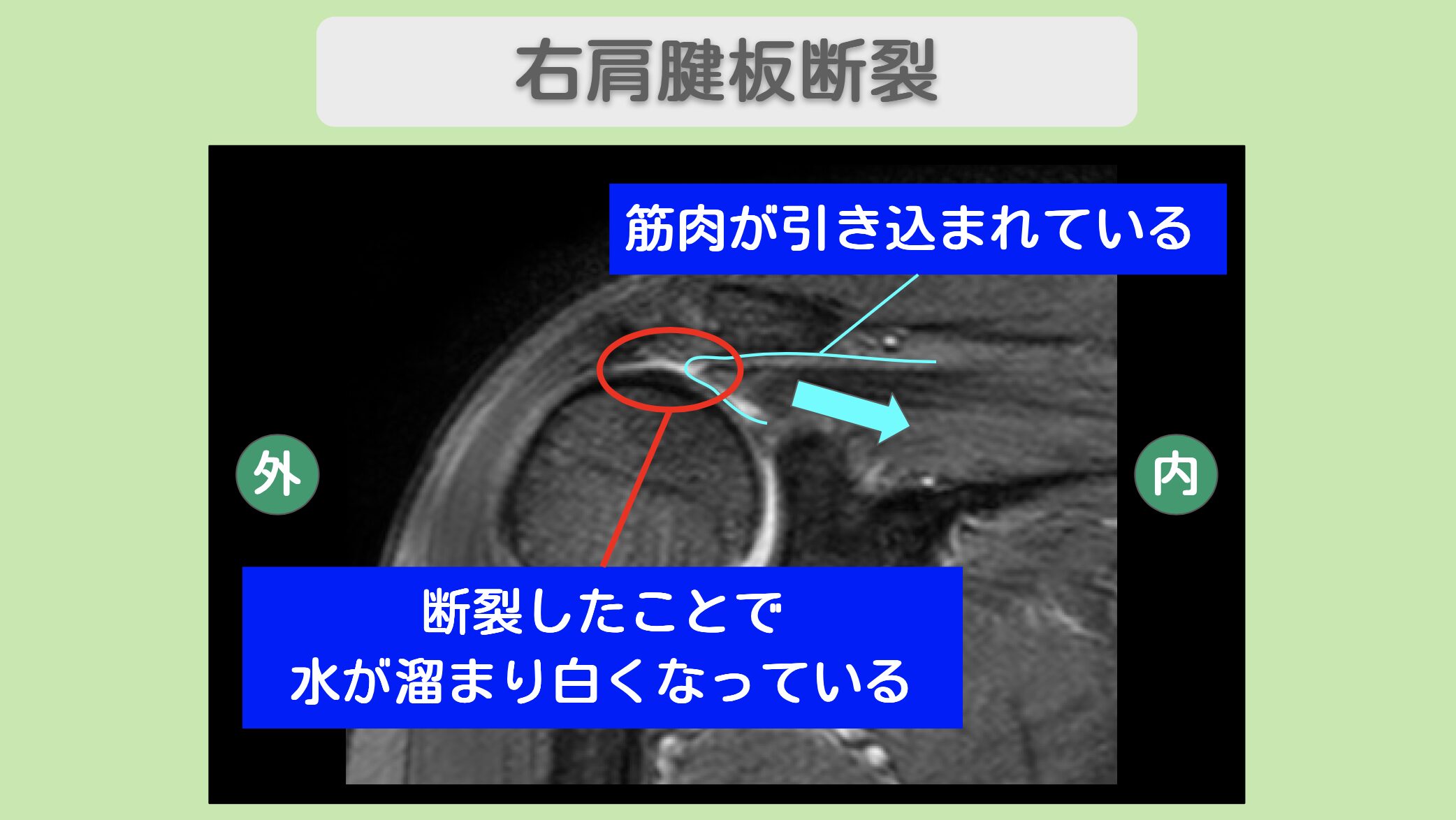 右肩腱板断裂のMRI所見