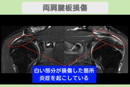 両肩腱板損傷