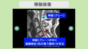 頚髄損傷