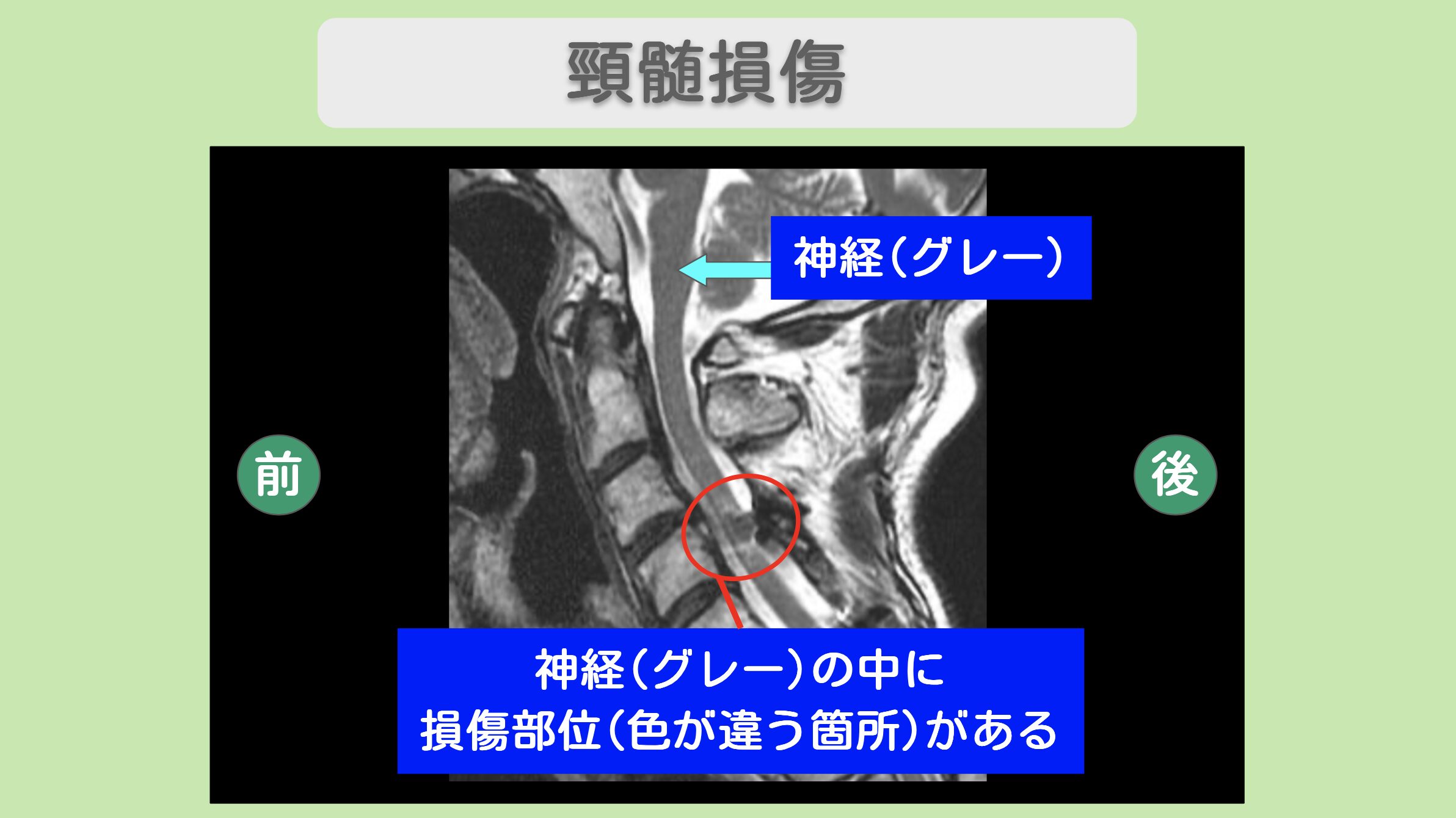 頚髄損傷