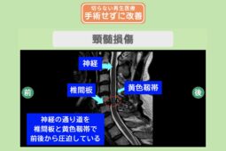 脊髄損傷