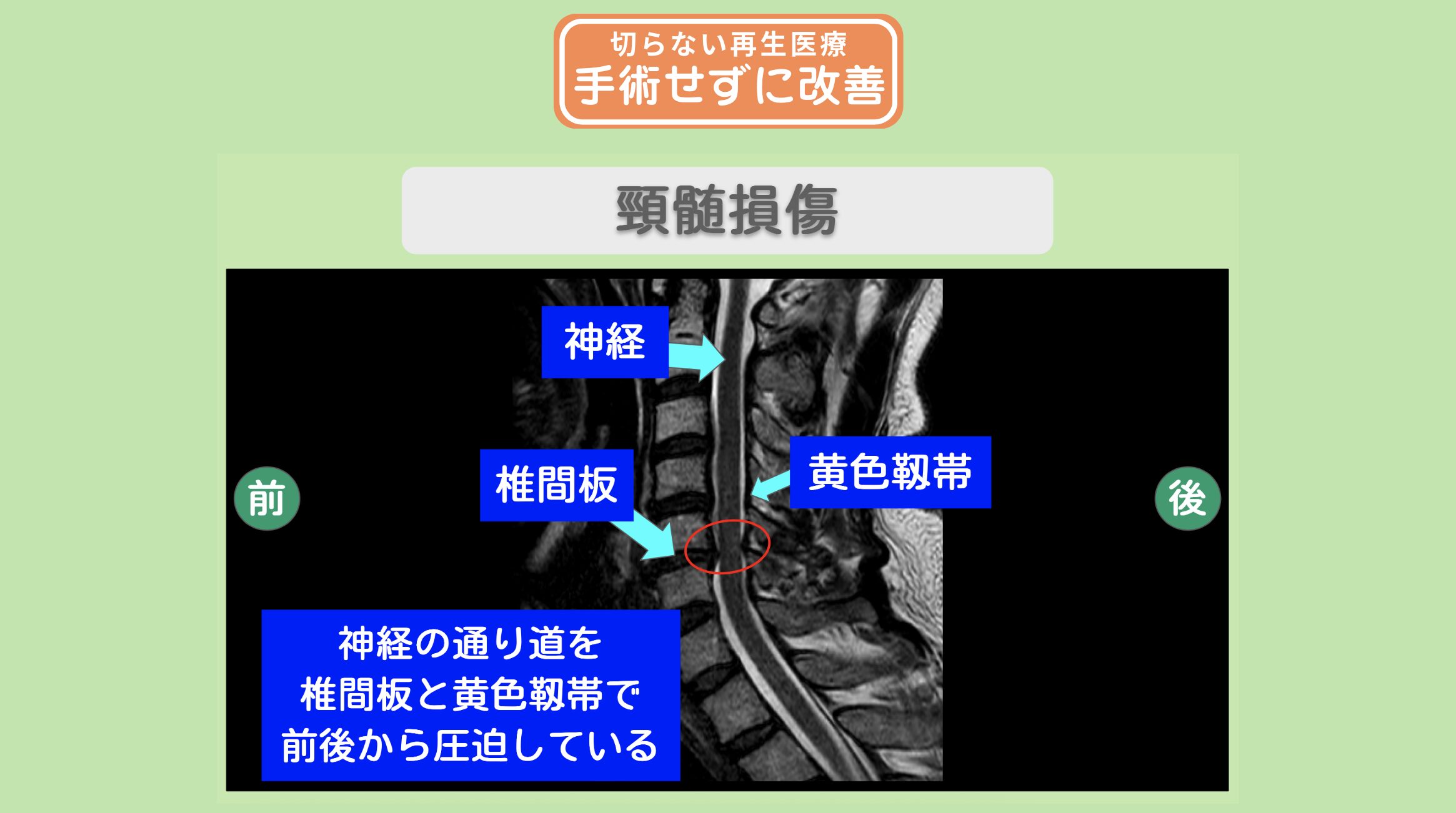 脊髄損傷