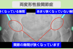 股関節のレントゲン画像