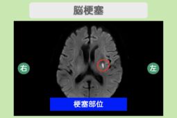 脳梗塞のMRI所見
