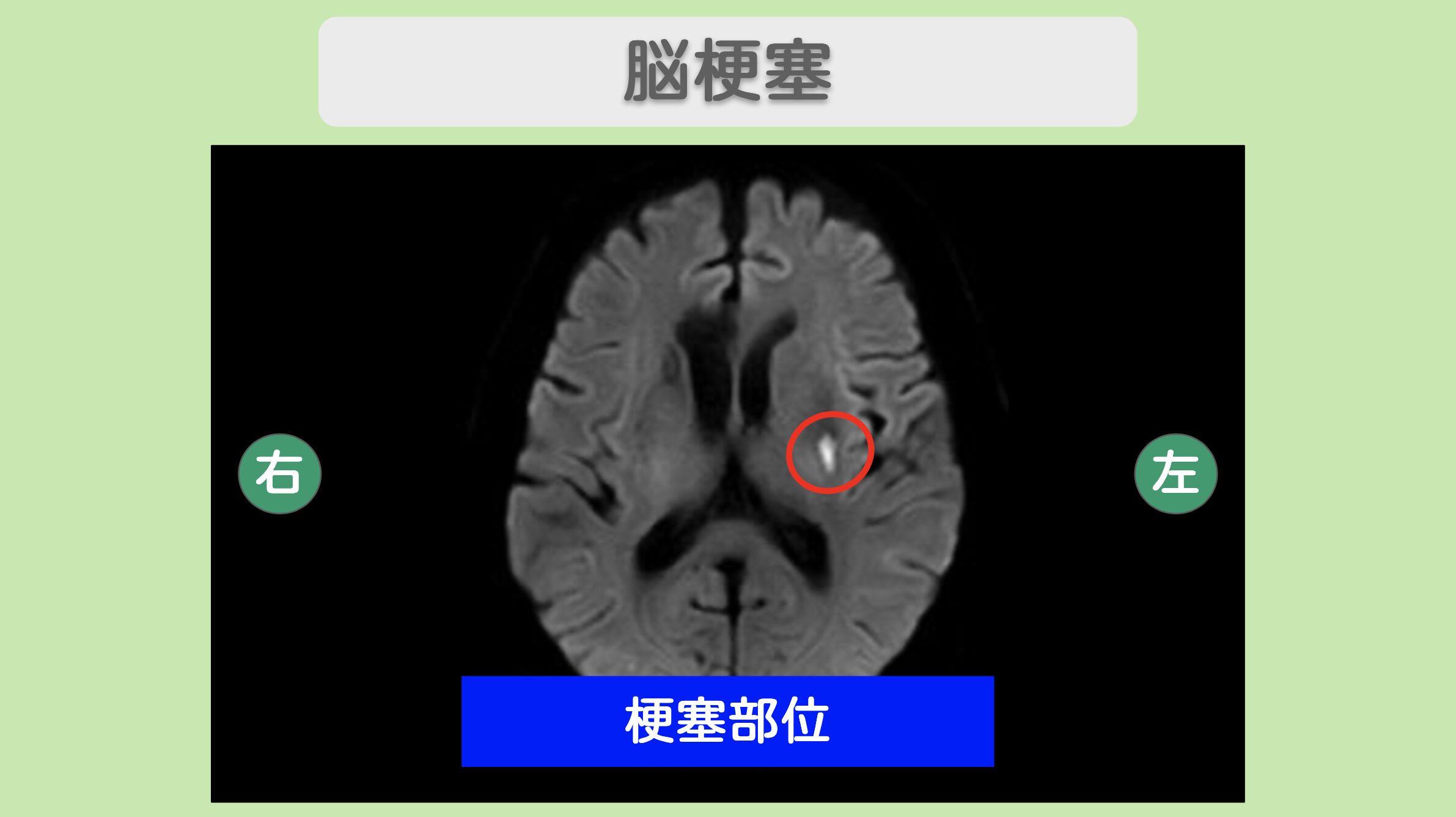 脳梗塞のMRI所見