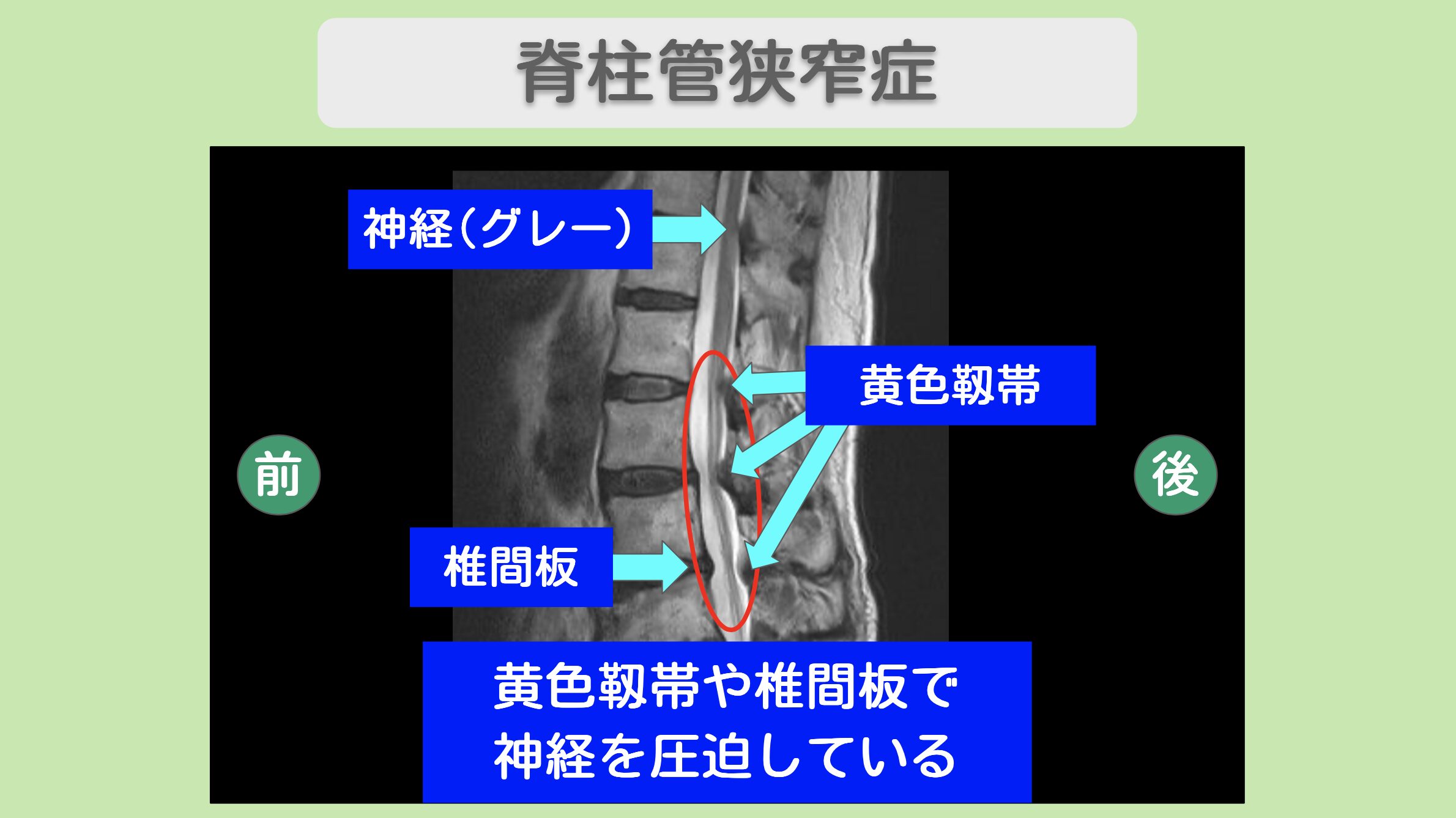 腰部脊柱管狭窄症のMRI所見