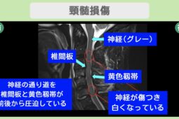 頚髄損傷のMRI所見
