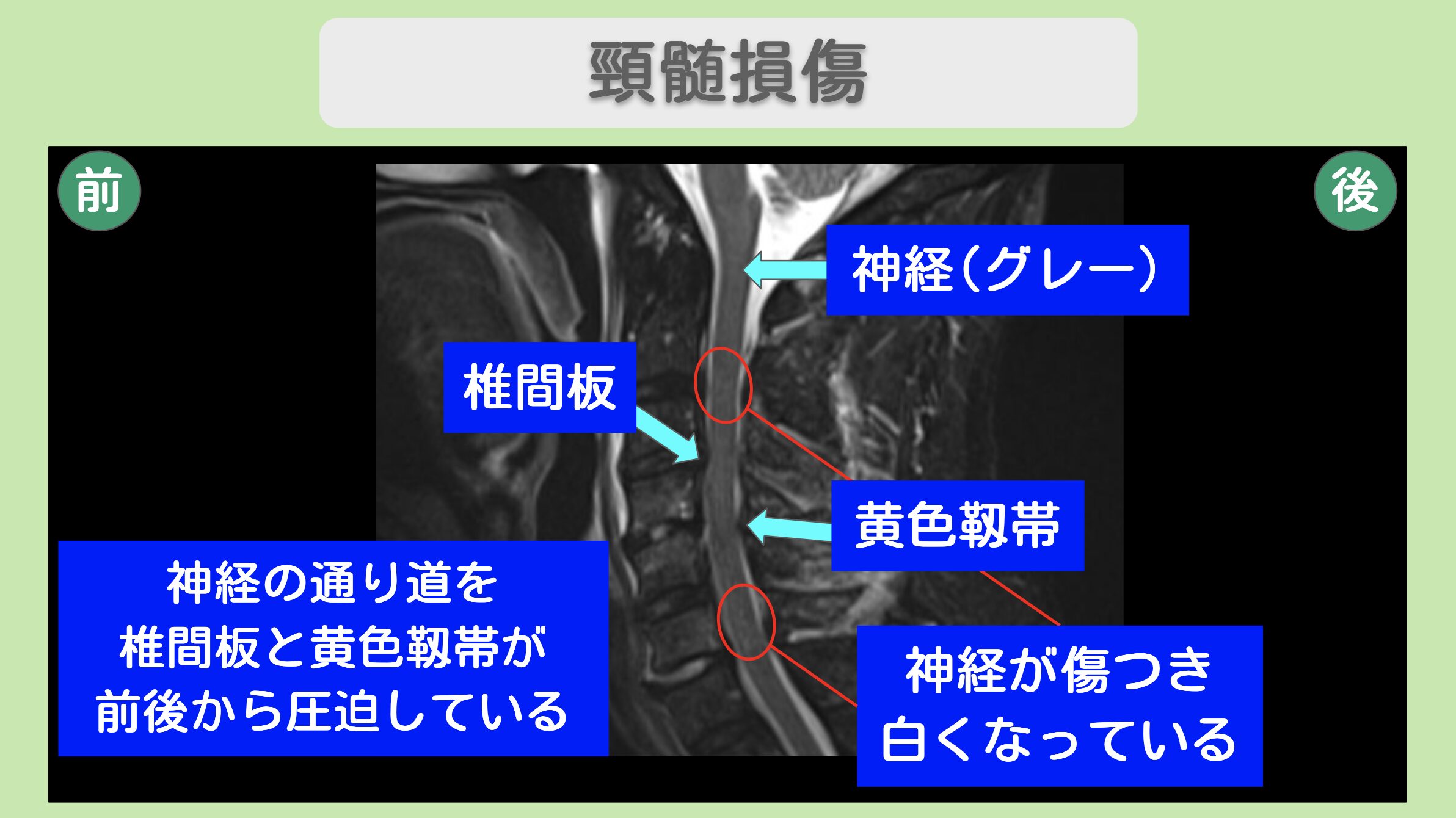頚髄損傷のMRI所見