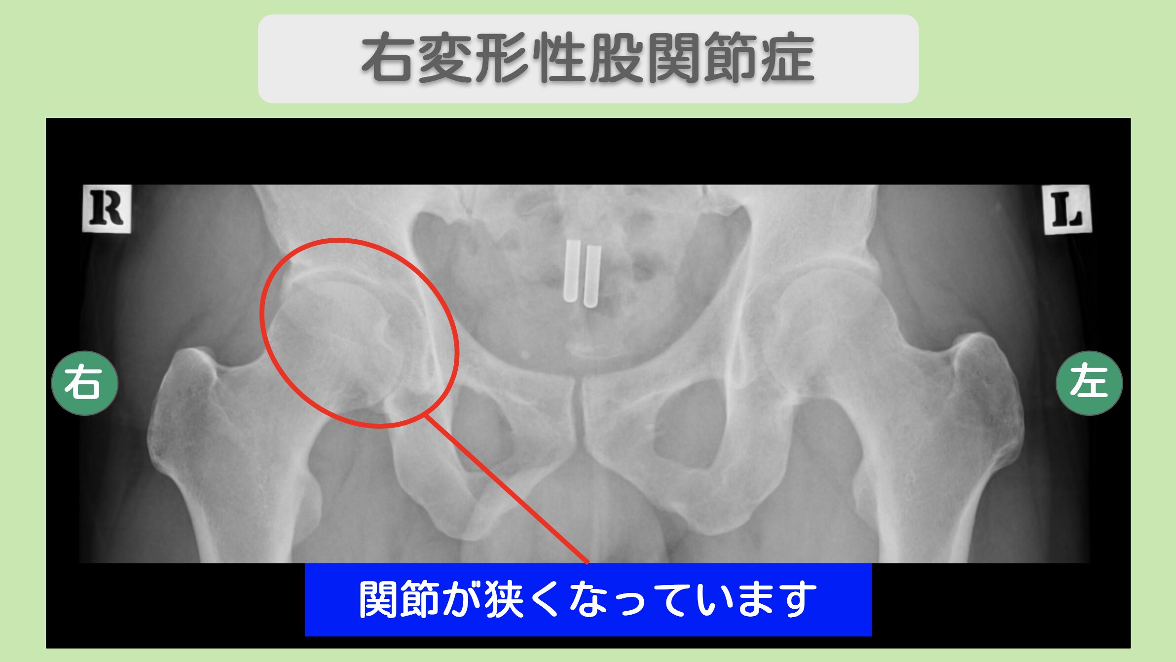 右変形性股関節症のレントゲン所見