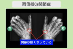 両母指CM関節症のレントゲン所見
