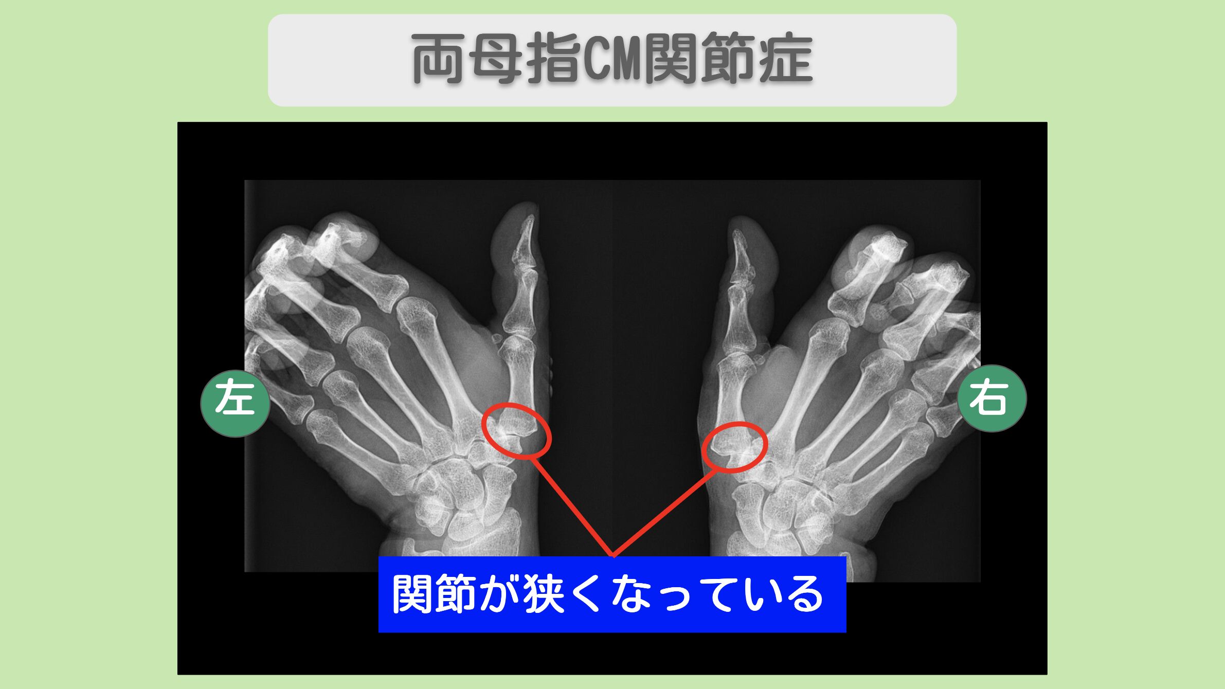 両母指CM関節症のレントゲン所見