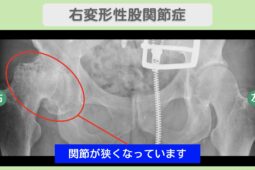 右変形性股関節症のレントゲン所見