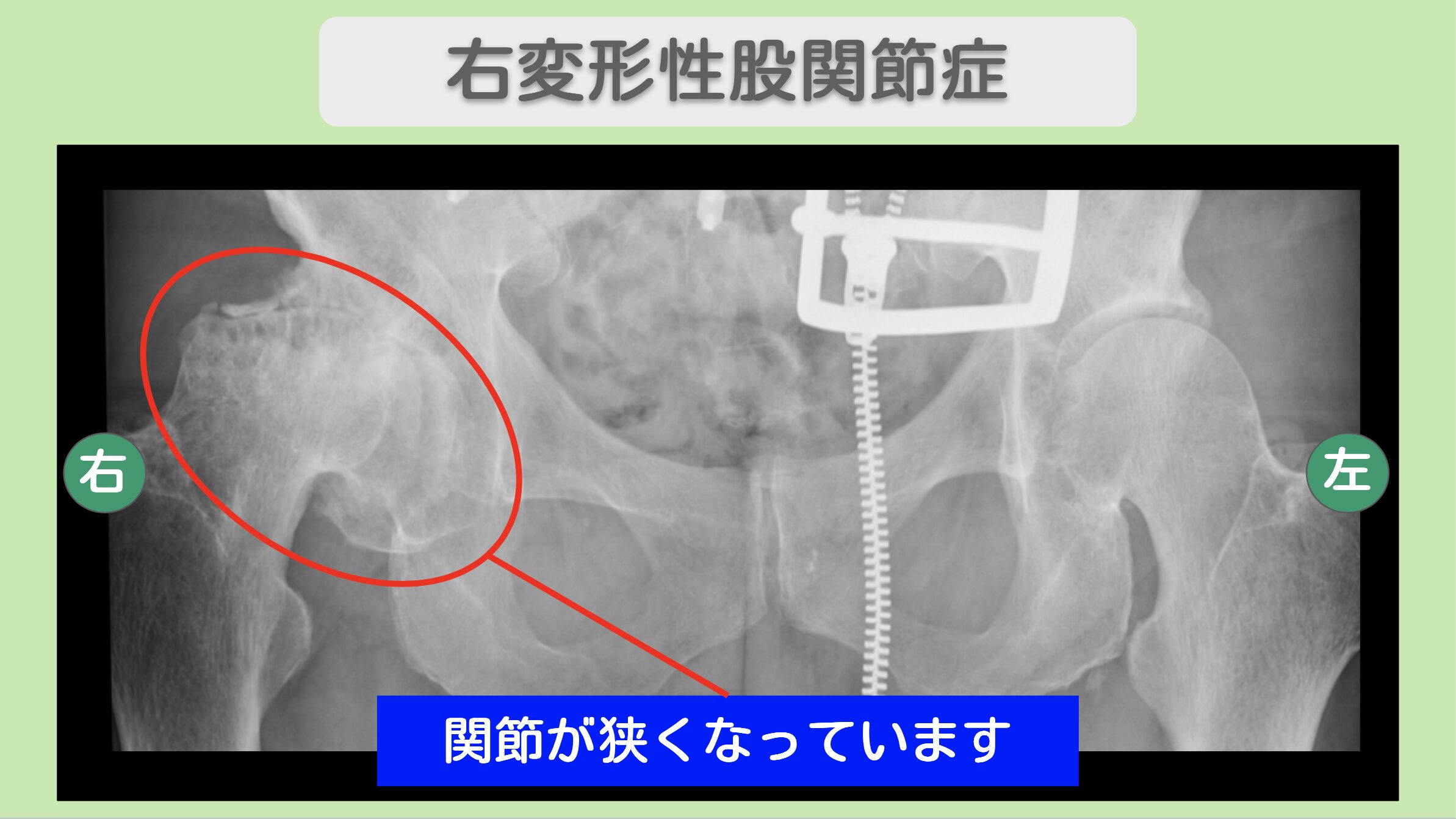 右変形性股関節症のレントゲン所見