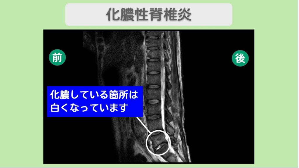 化膿性脊椎炎術後・腹部大動脈瘤術後の脊髄損傷(治療前後MRI比較)