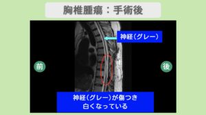 胸椎腫瘍術後の脊髄麻痺 MRI所見