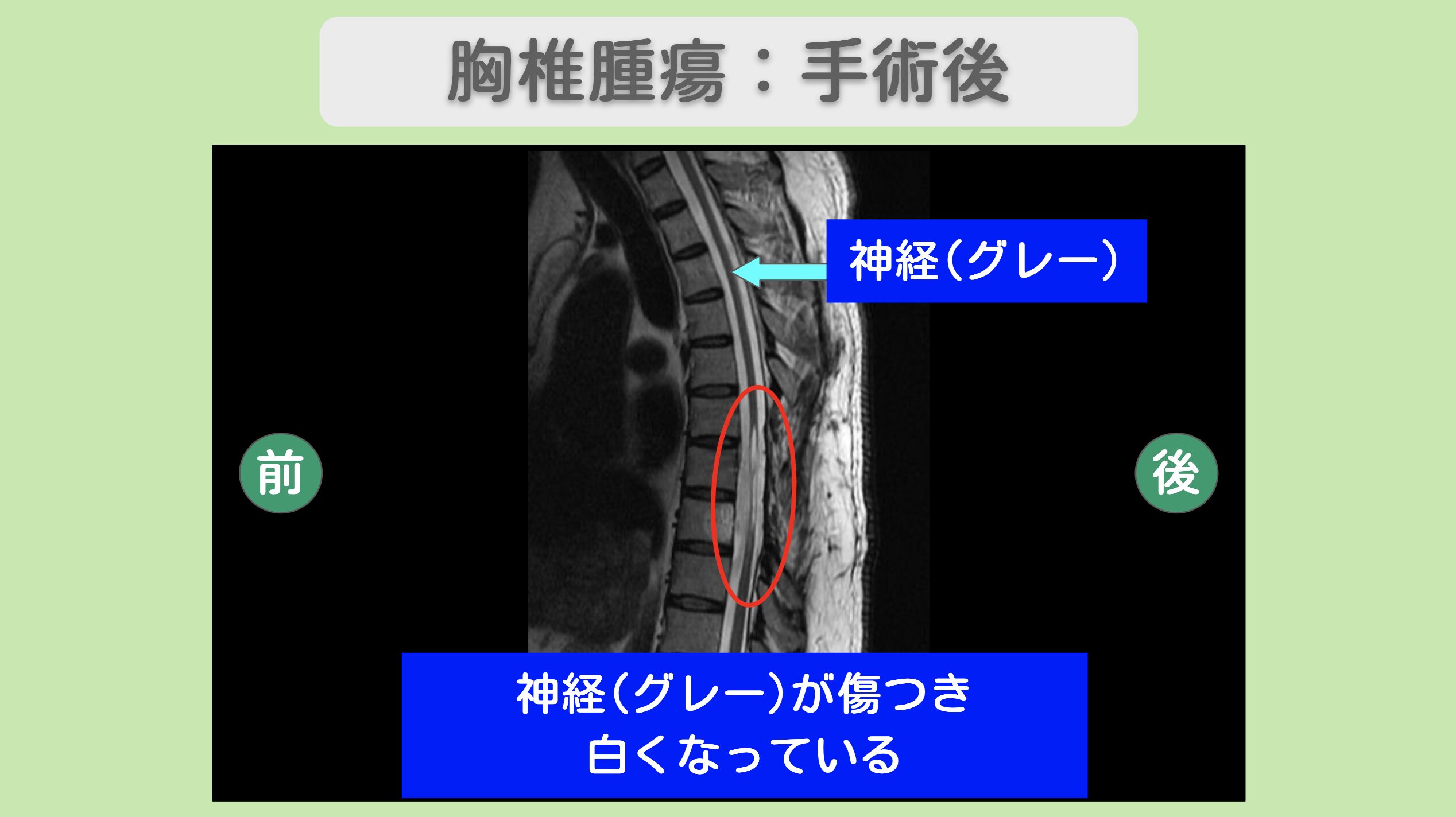 胸椎腫瘍術後の脊髄麻痺 MRI所見